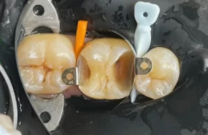 zubné výplne, proces odstraňovania kazu