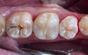 Zub po ošetrení kazu, biele výplne, biela fotokompozitná výplň, liečba kazov